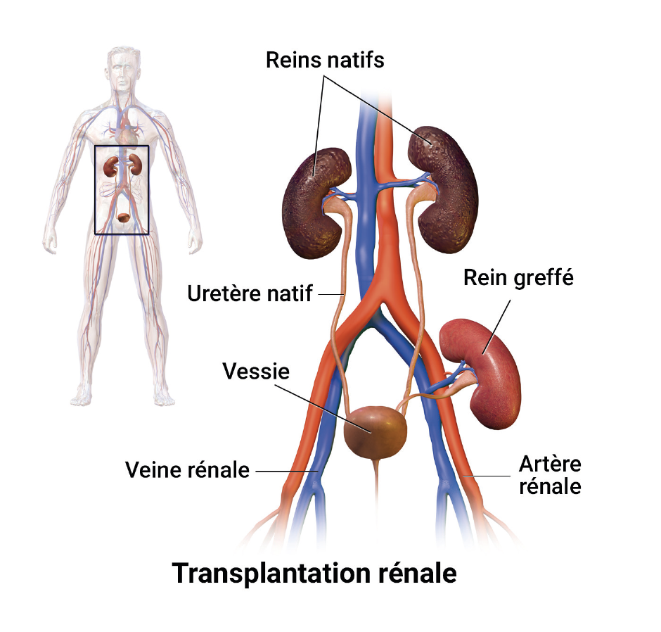 La Transplantation Rénale Un Nouveau Départ Chl